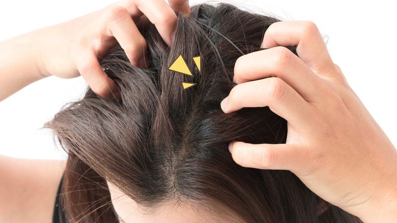 Simak Sob! Berikut 5 Penyebab Ketombe Pada Rambut