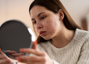 Kenali Cara Memilih Serum Tepat untuk Hilangkan Noda Jerawat